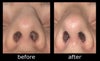 Nose tip - pre & post rhinoseptoplasty