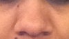 nose BEFORE reduction