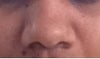 nose AFTER reduction