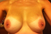 Left breast obviously smaller, this was the redo side. Other side was never a problem!