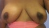 7 months post op