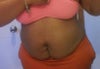 I want a tummy tuck after 4 c-sections