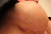 incision area post op day 25