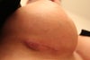 3rd picture of area. Post op day 25