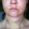Post-op 3 weeks with bruising in jowl area