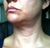 Post-op current