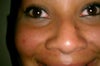 front view, bump most noticeable when smiling