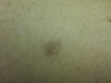 Mark left after using Dr Scholls Freeze Away