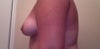 Seemingly flatter than normal? Is nipple in correct position as opposed to a downward position for Tubular Breasts?