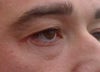 Right eye hollowing or cheek raised
