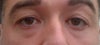 Tear troughs still prominent,