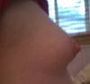 No Swelling From Side