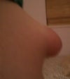 Swelling From Side