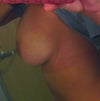 Arm slightly elevated. Right breast profile.
