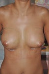 Few days post op, it looks different already, left breast nipple looks down.