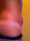 had this bulge after pregnancy, got it lipo flat, now bulging again after mini tummy tuck