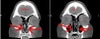 One before/after shot of my turbinate reduction.