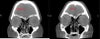 Another slice of my before/after CT scans