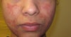 Front view of face after 24 hours