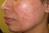 Side view of face after 24 hours