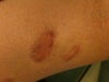 scar