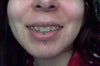 Smiling mouth (getting the braces off in 1 month)