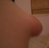 Side View when nipple is swollen
