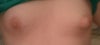 Front View of Nipples during the transition of swollen to unswollen. One nipple is completely unswollen, the other still a little swollen, but going down.