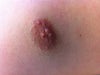 Irregular nipple(s)
