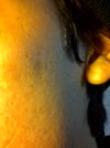 Acne Scaring Left cheek