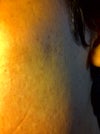 Acne Scaring Left cheek