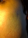 Acne Scaring Left cheek