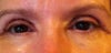 Inner eye skin