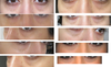 Photos of the under eye area in different lights and angles. The last 2 on the left side are ones with makeup, which you can see does not help with hollows.