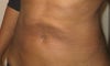 crater around belly button