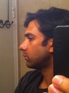 Left profile view of nose 11 days after rhinoplasty surgery