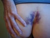 One week post op