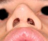 The left hand side has a more curved cartilage indent inside the nostril, even though it is fuller on the left on the outside.