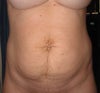 As you can see the Xiphoid is dose not really show much. It protrudes just a little at about the same spot as were the mole between my breast is but on the other side. Just right (my right) of center.