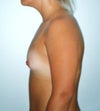 Note: Areola puffiness and breast shape look improved due to nipple hardness and contraction of skin