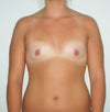 Note: Areola puffiness and breast shape look improved due to nipple hardness and contraction of skin