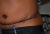 Bunching Scar