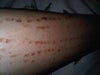 left leg burns which are darkening over days