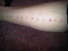 right leg blisters and burns