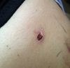 11 days after smart lipo