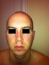 new nose September 2012 (2 years 5 months post rhinoplasty)