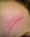 front of scar