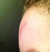 side view of scar