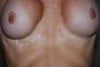 Front View arms overhead - note scarring under right breast
