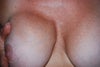 Right breast pushing medially